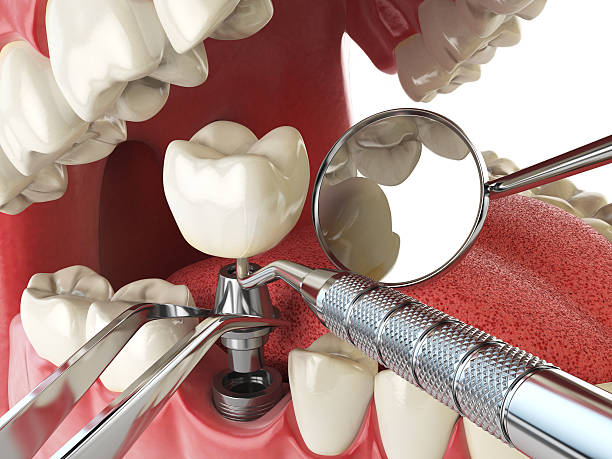 Best Emergency Tooth Extraction in Hamlet, NC